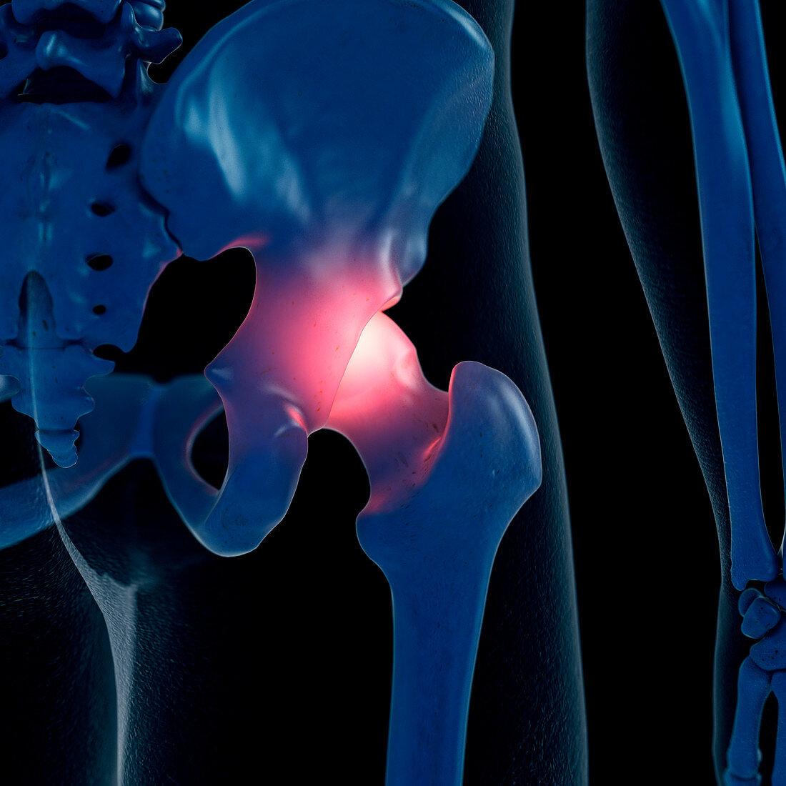 Illustration of a painful hip joint
