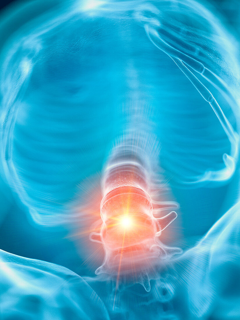 Illustration of a painful lower spine