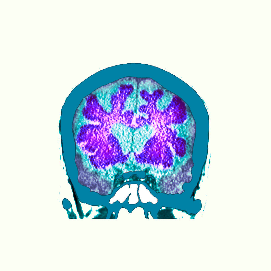 Brain in dementia, CT scan