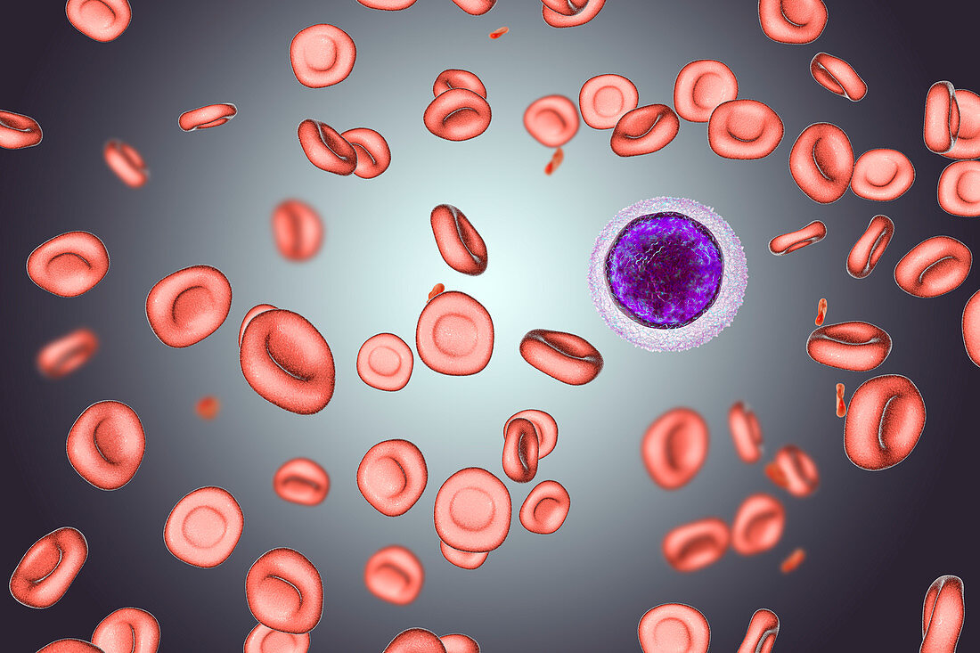 Iron deficiency anaemia, illustration