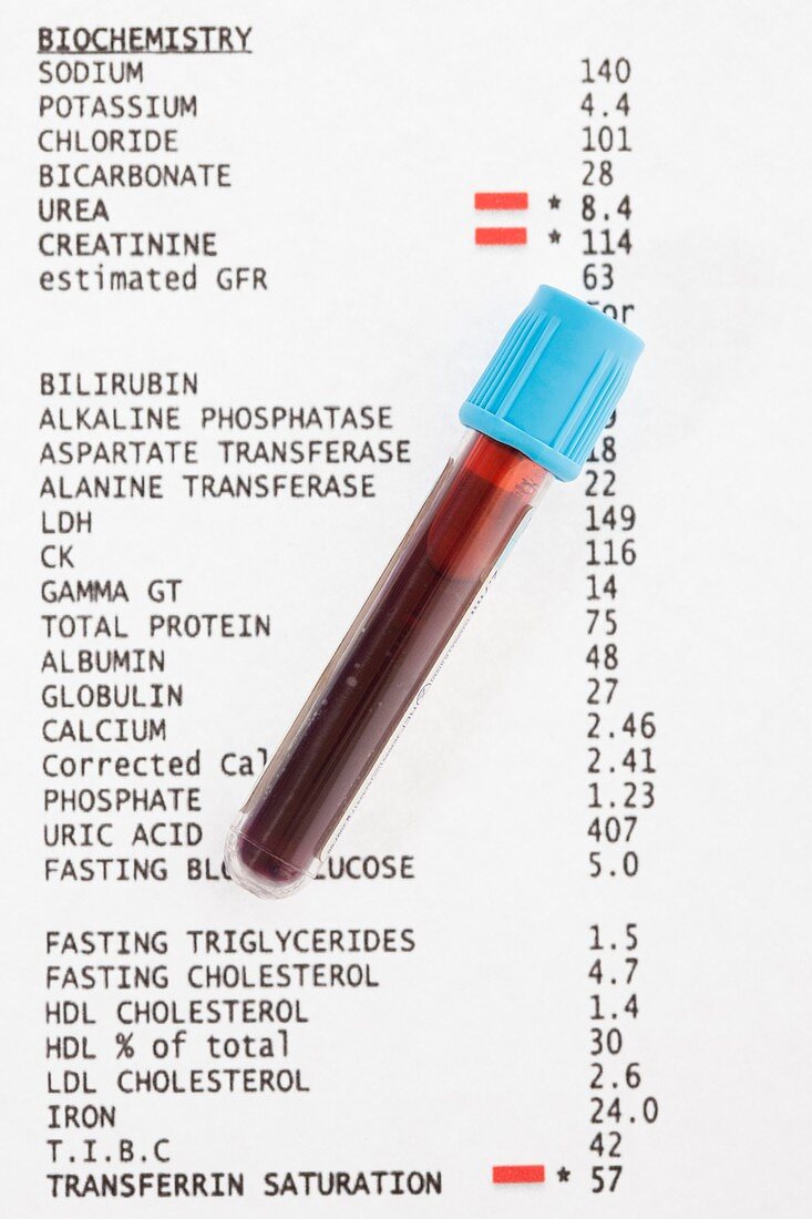 Blood test results with blood sample