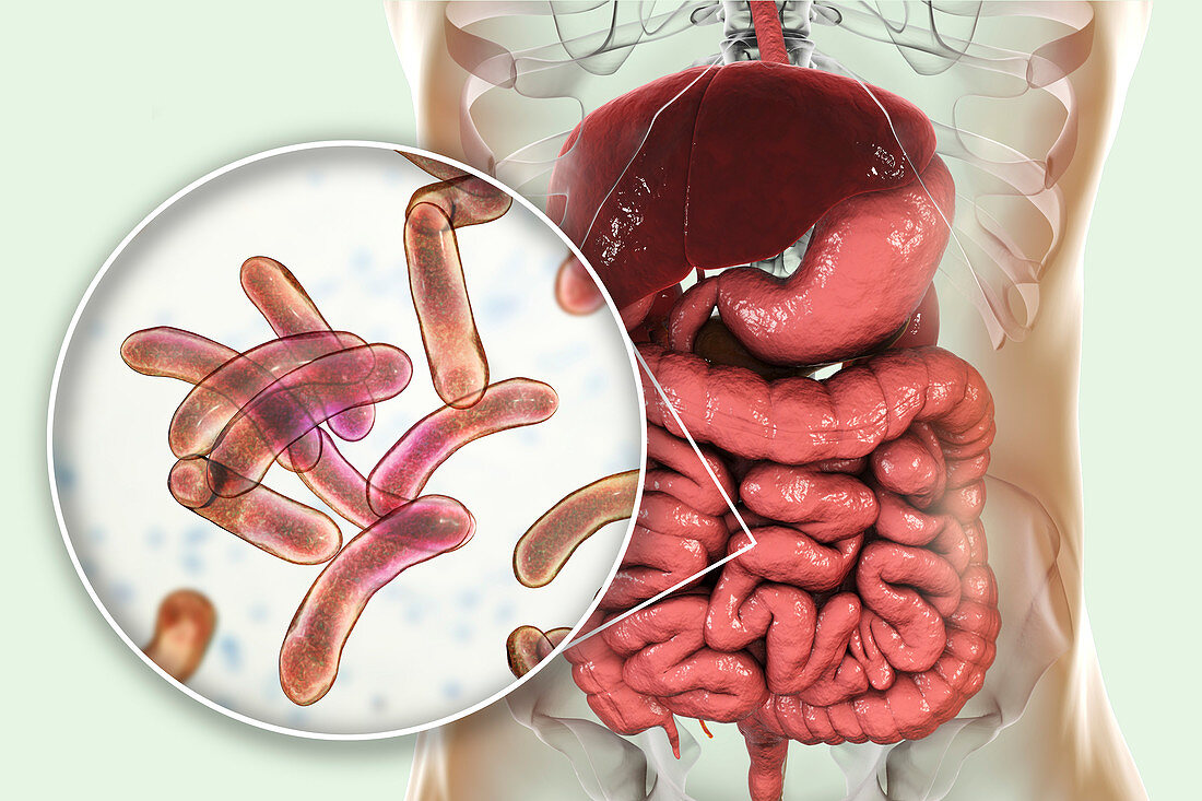 Cholera infection, illustration