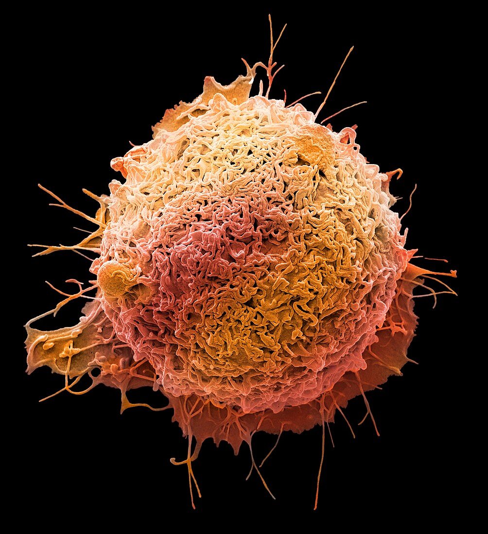 Colorectal cancer cell, sem