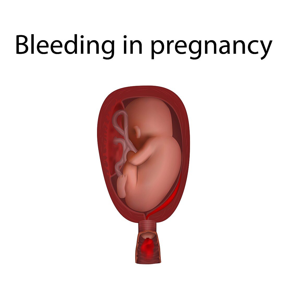 Bleeding in pregnancy, illustration