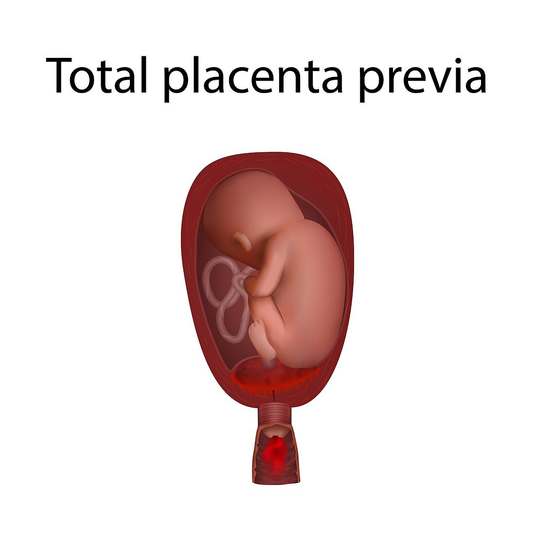 Total placenta previa, illustration