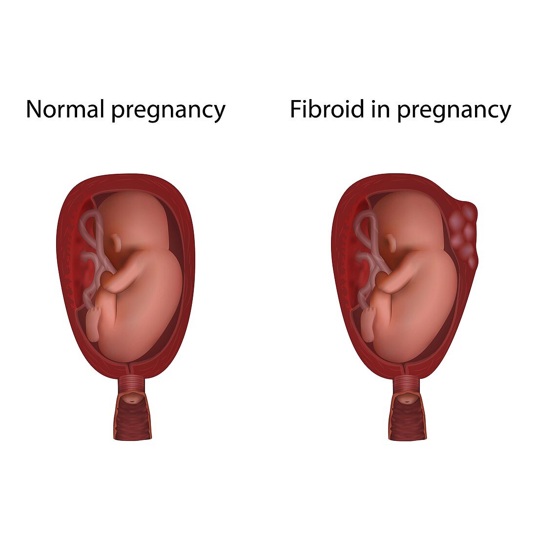 Fibroid in pregnancy and normal pregnancy, illustration