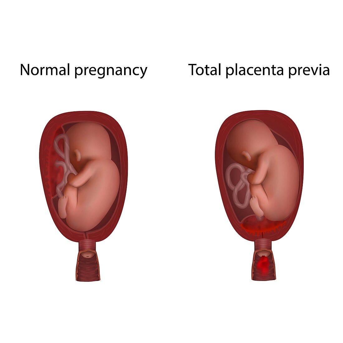 Total placenta previa and normal pregnancy, illustration