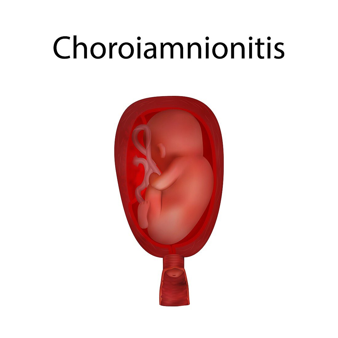 Choroiamnionitis, illustration