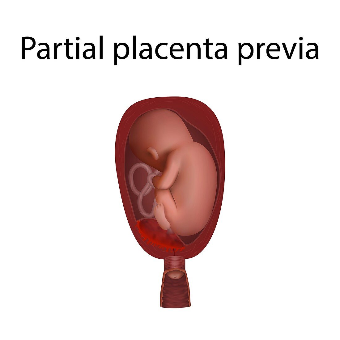 Partial placenta previa, illustration