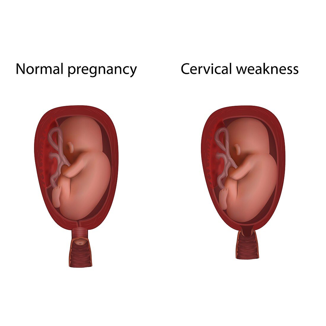 Cervical weakness and normal pregnancy, illustration