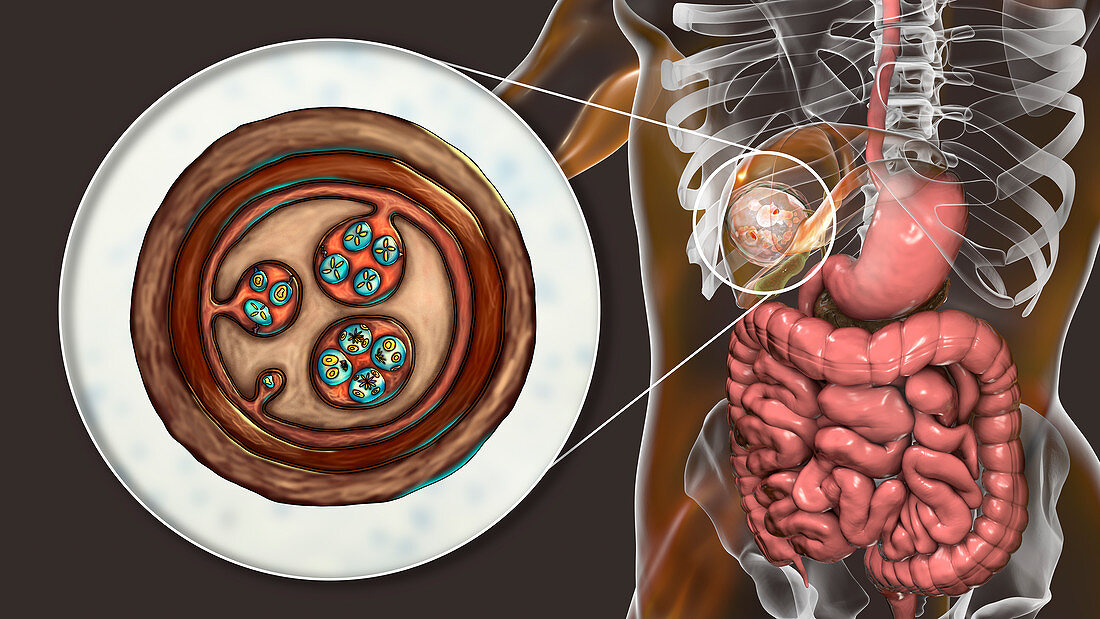 Hydatid disease in liver, cystic echinococcosis, illustratio