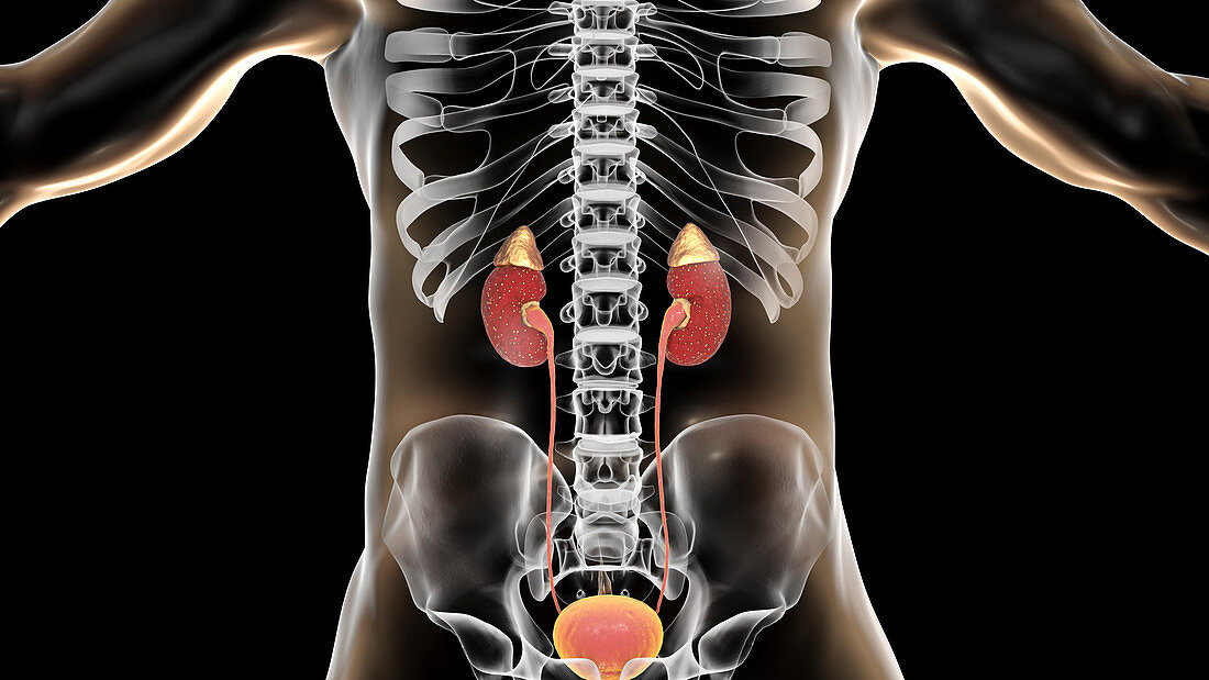 Acute pyelonephritis, illustration