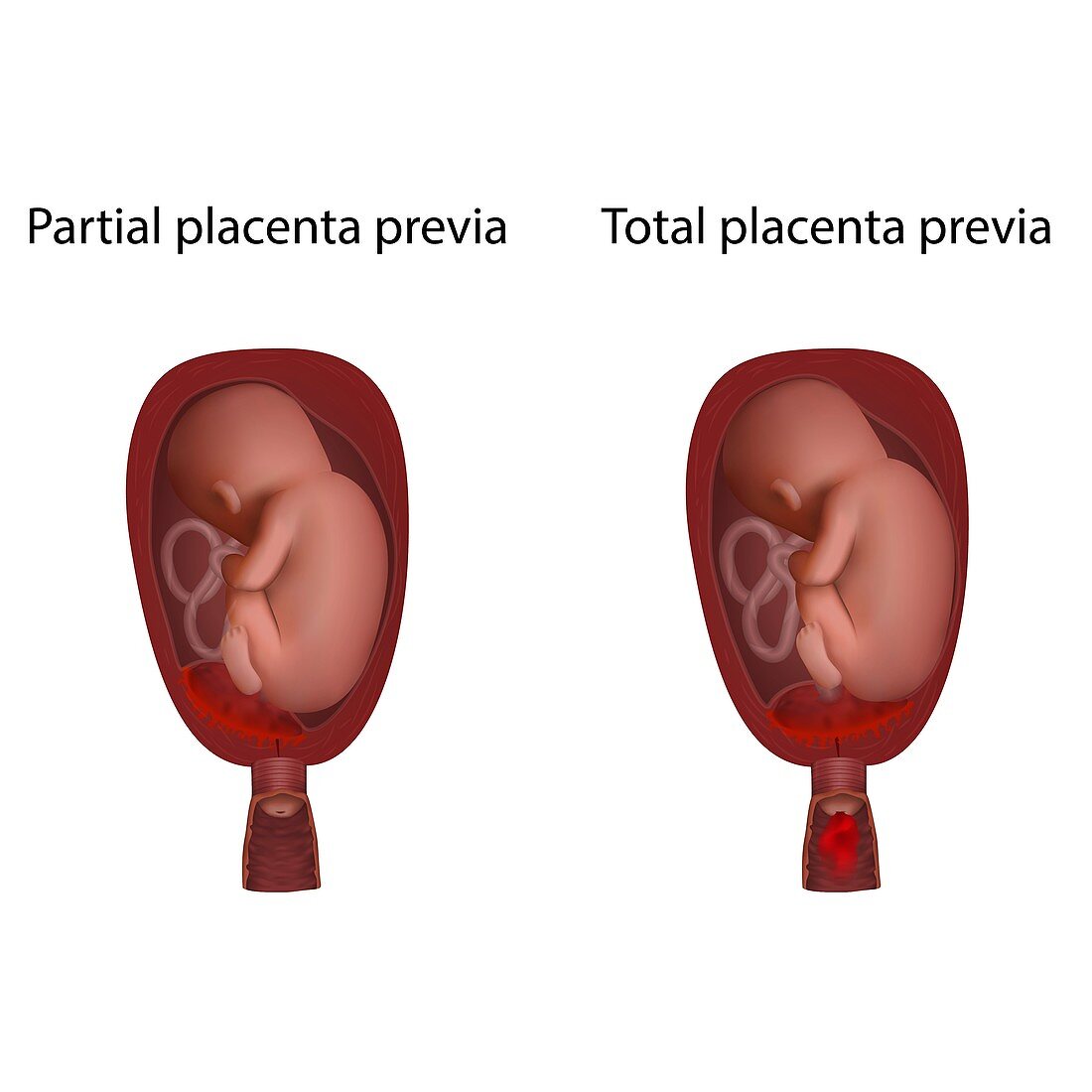 Partial and total placenta previa, illustration