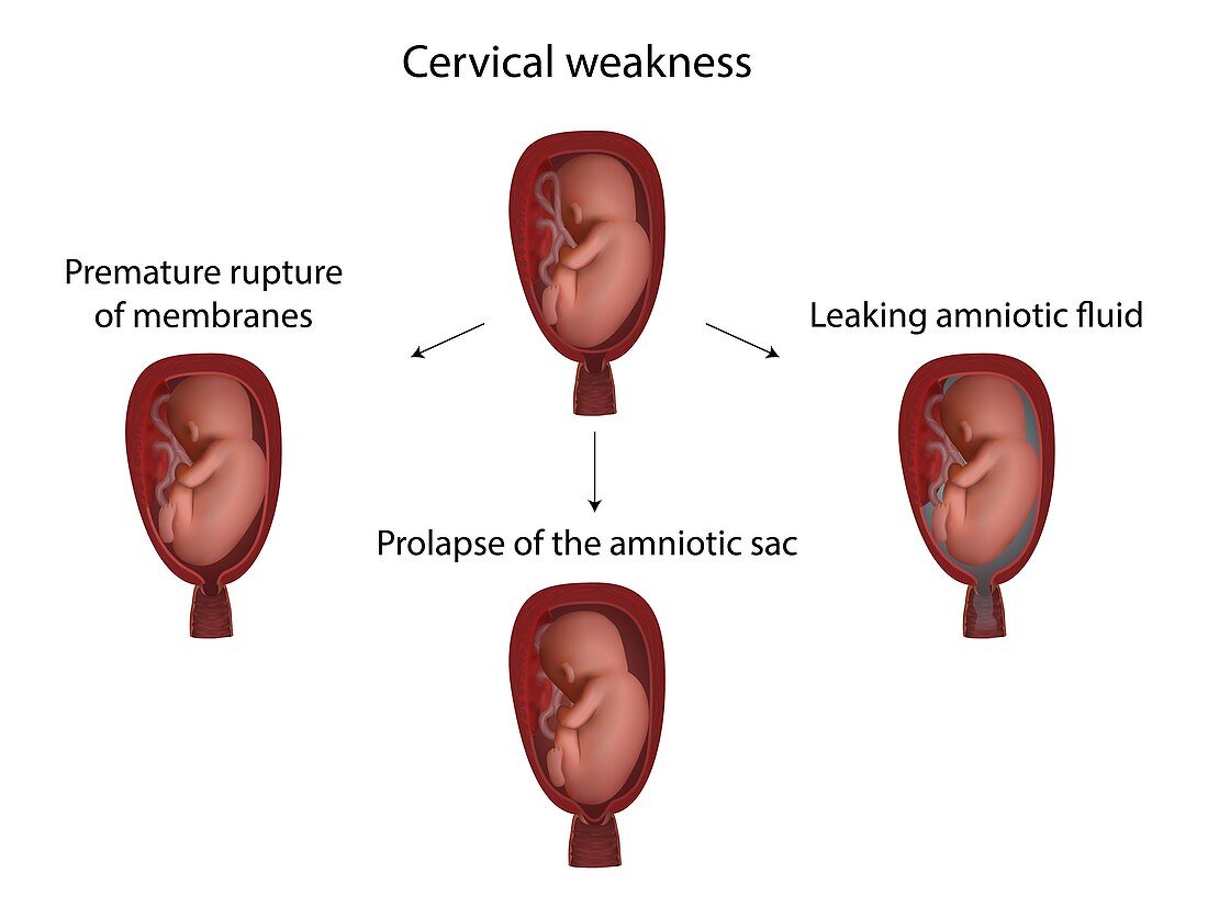 Cervical weakness complications, illustration