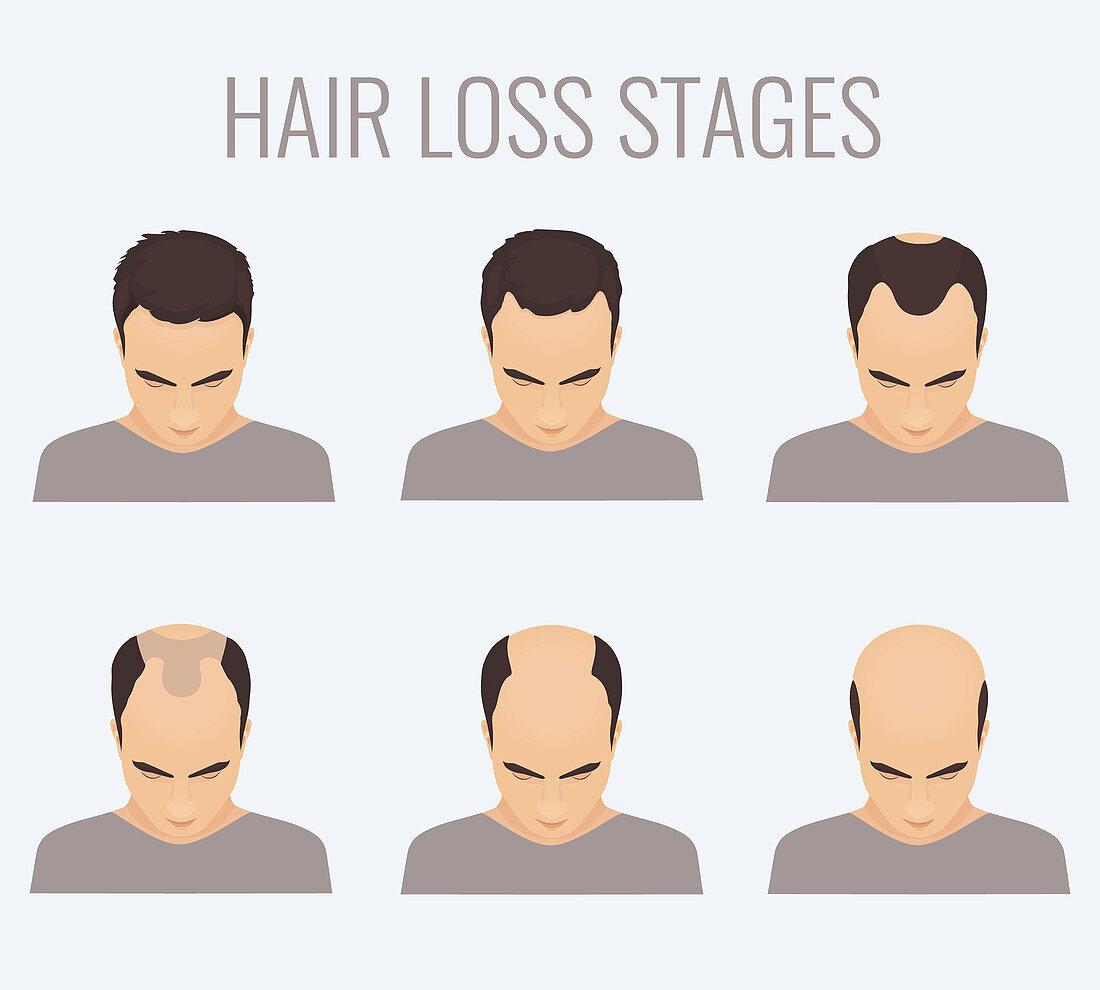 Male-pattern baldness stages, illustration