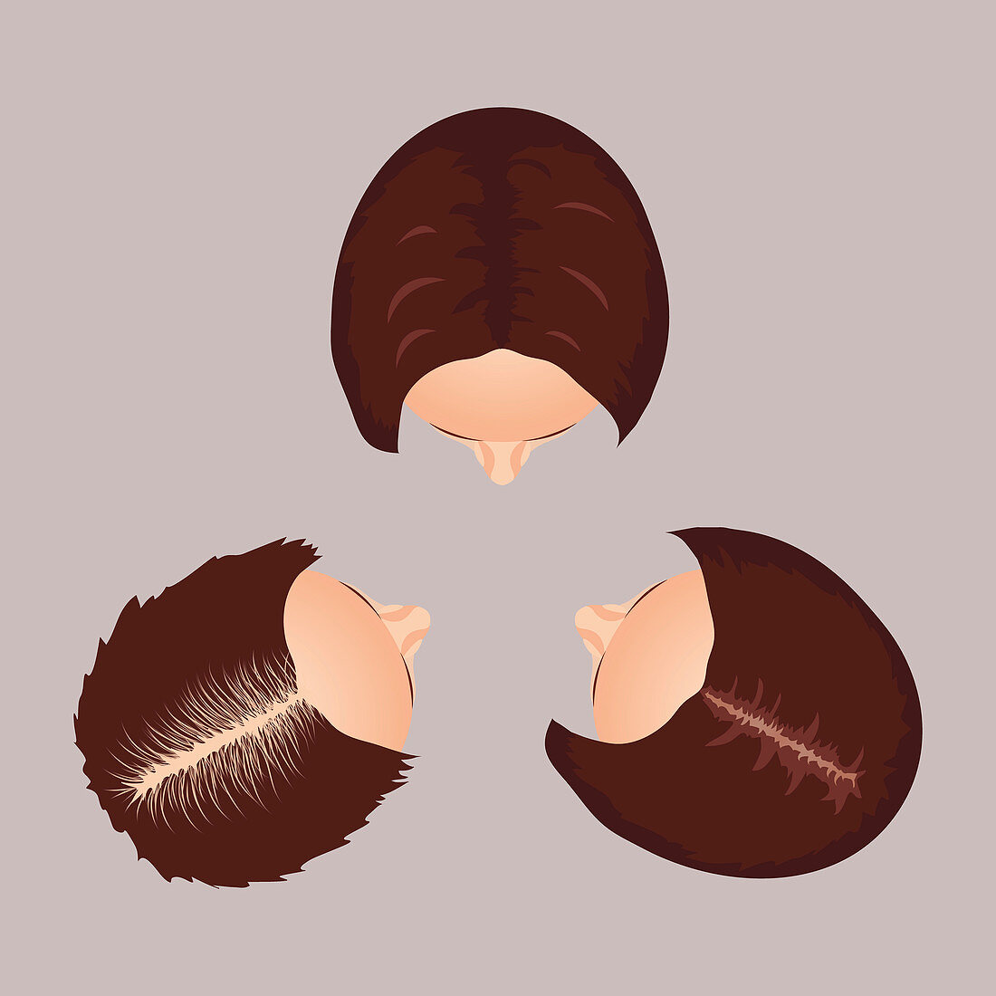 Female hair loss stages, illustration