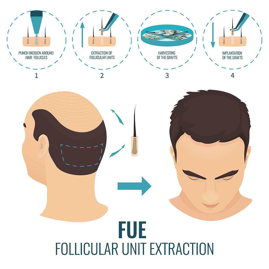 FUE hair loss treatment in men, illustration