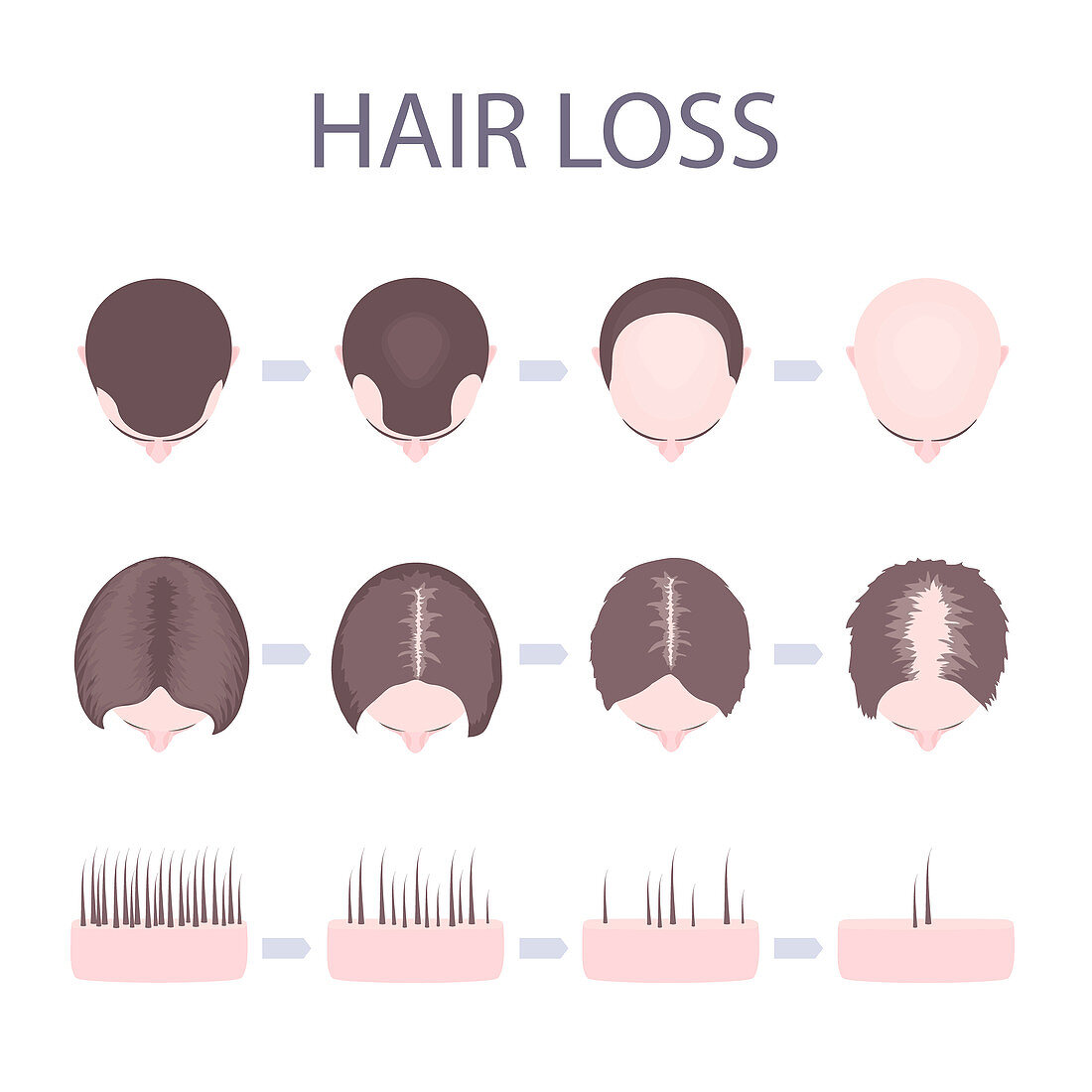 Male and female hair loss stages, illustration