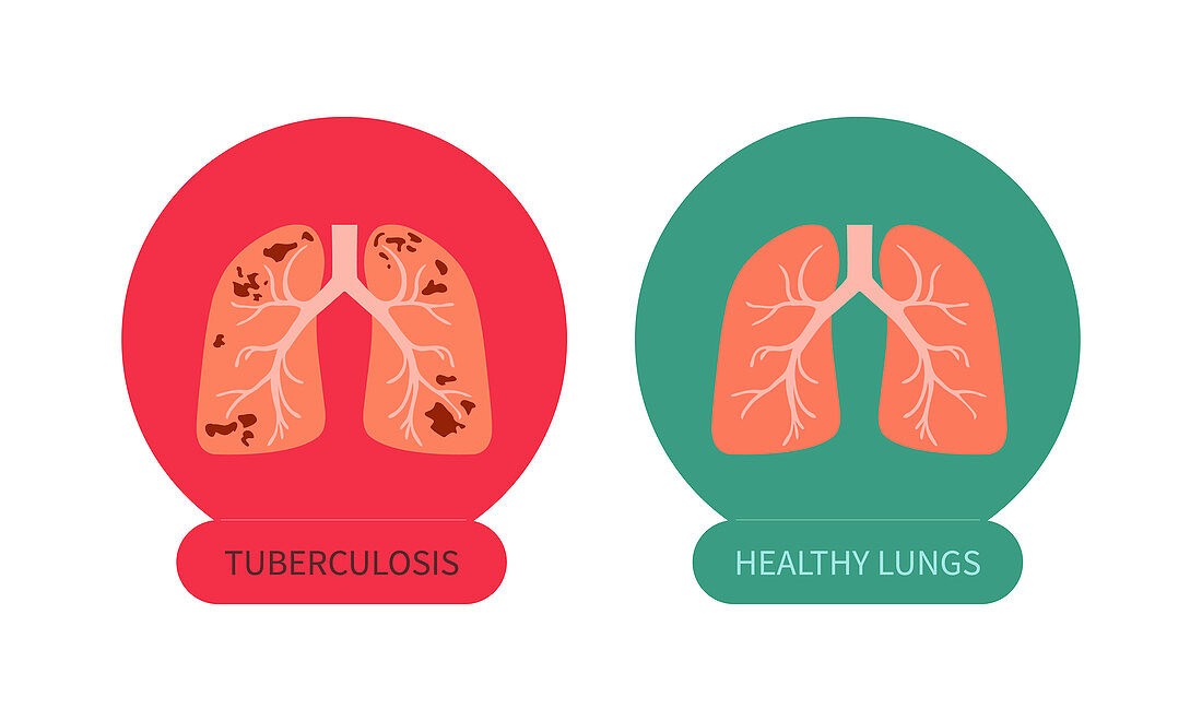 Lungs with tuberculosis and healthy lungs, illustration