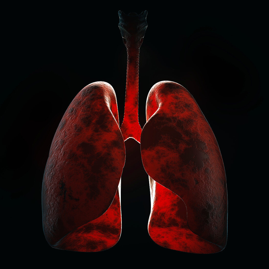 Lung infection, illustration