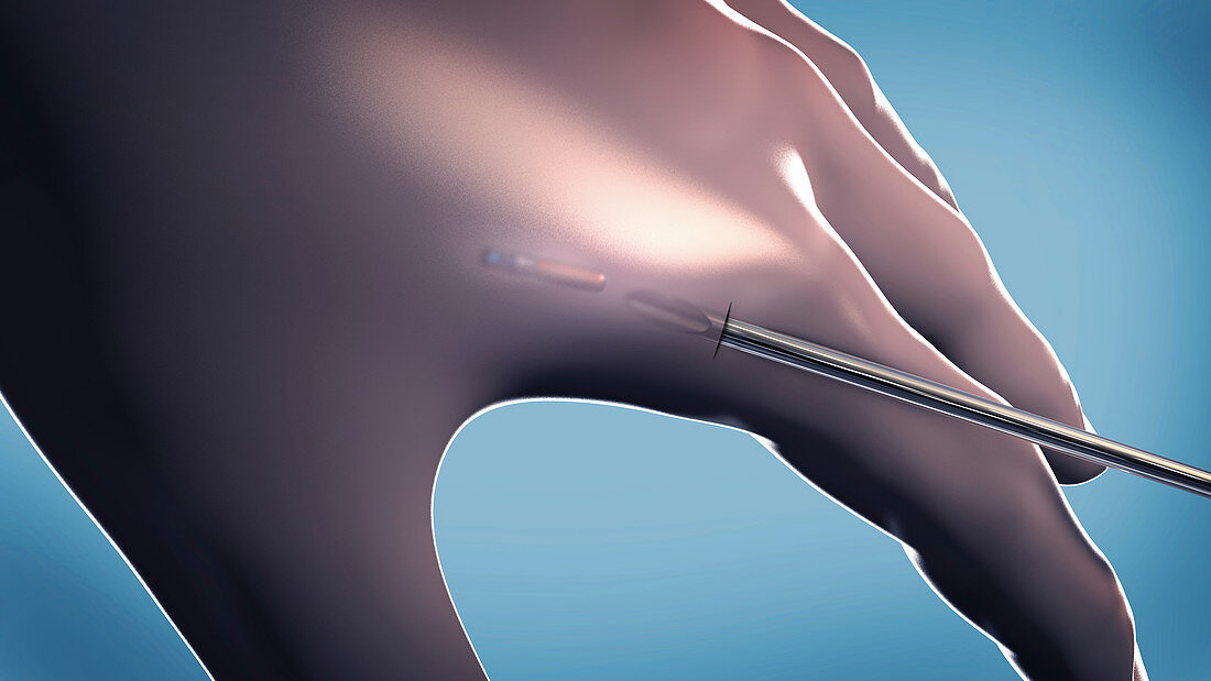 Microchip implanted in human hand, illustration
