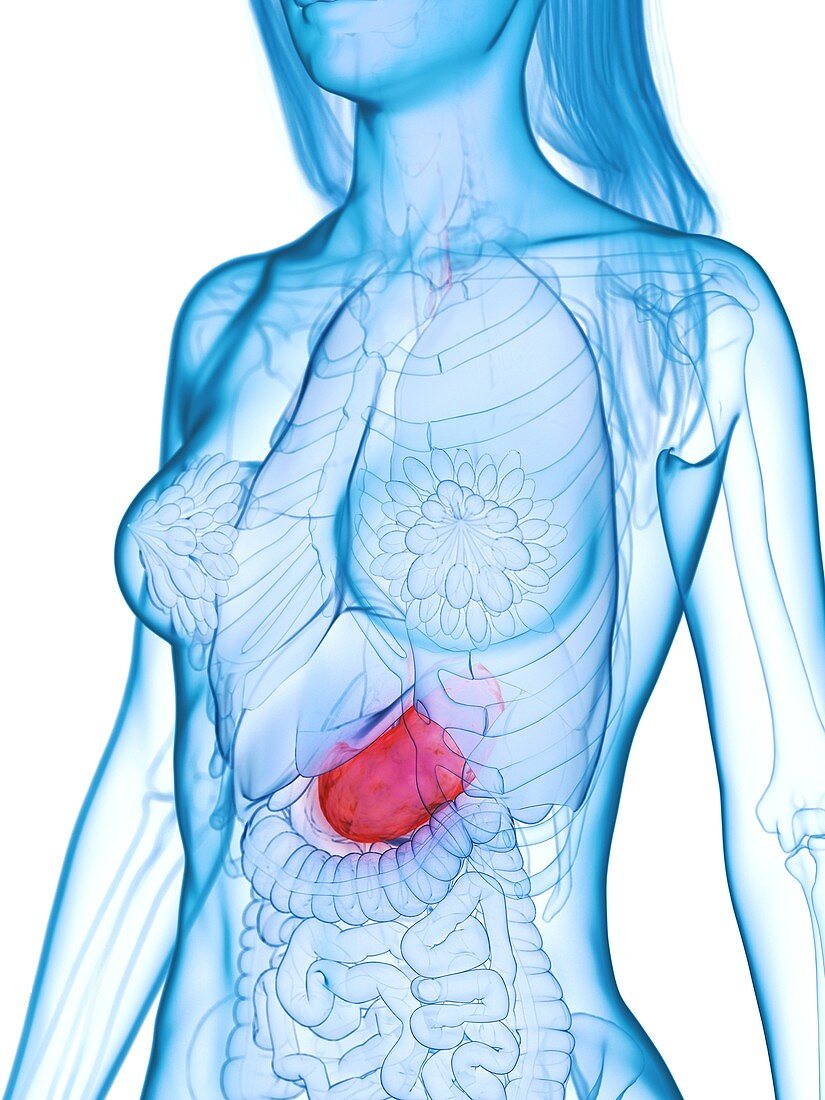 Diseased stomach, illustration