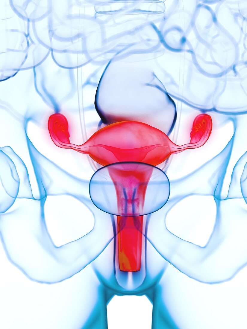 Diseased uterus, illustration