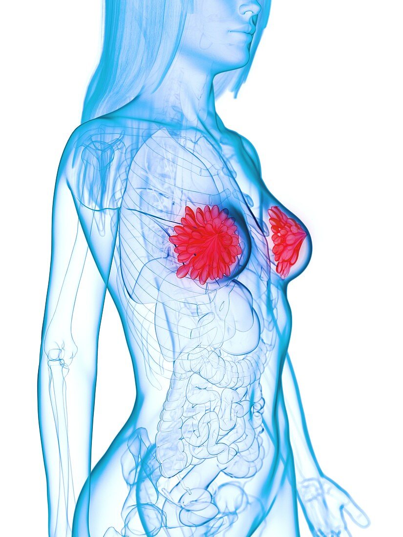 Diseased mammary glands, illustration