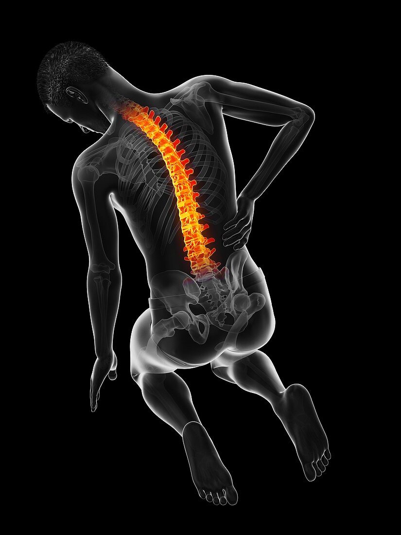 Acute back pain, illustration