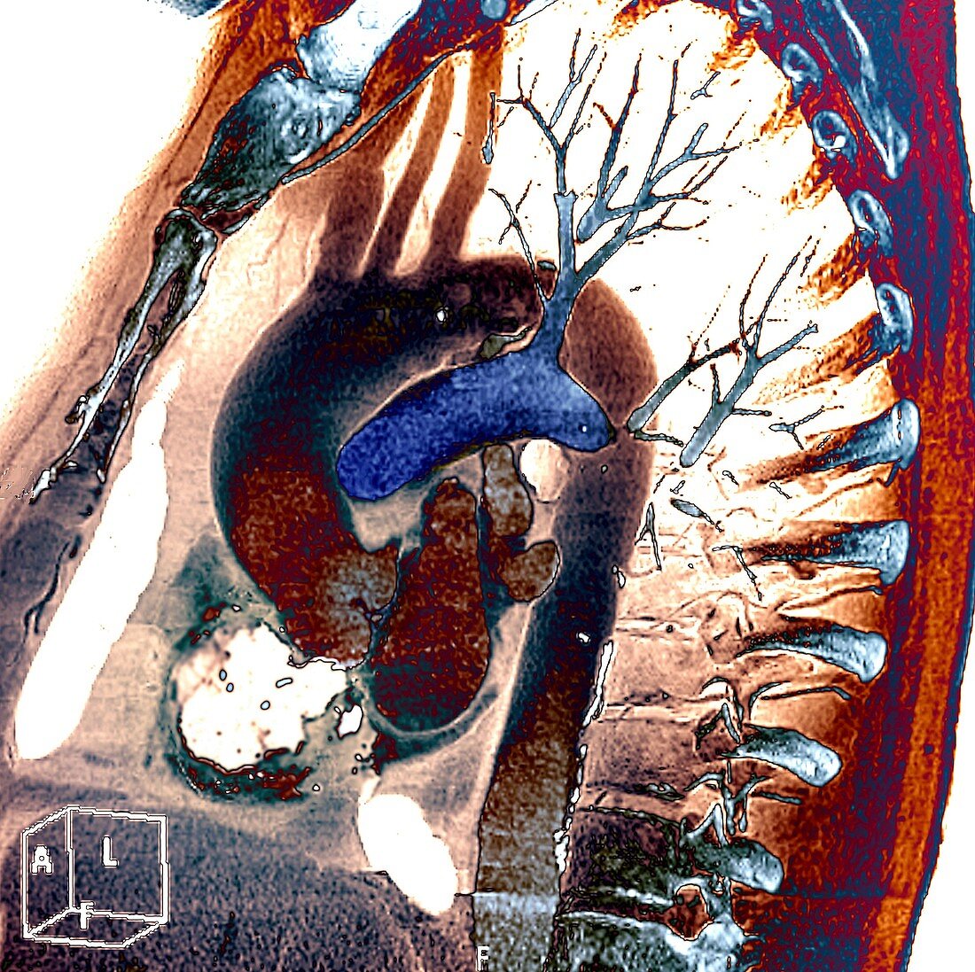 Aortic aneurysm stent, 3D CT scan