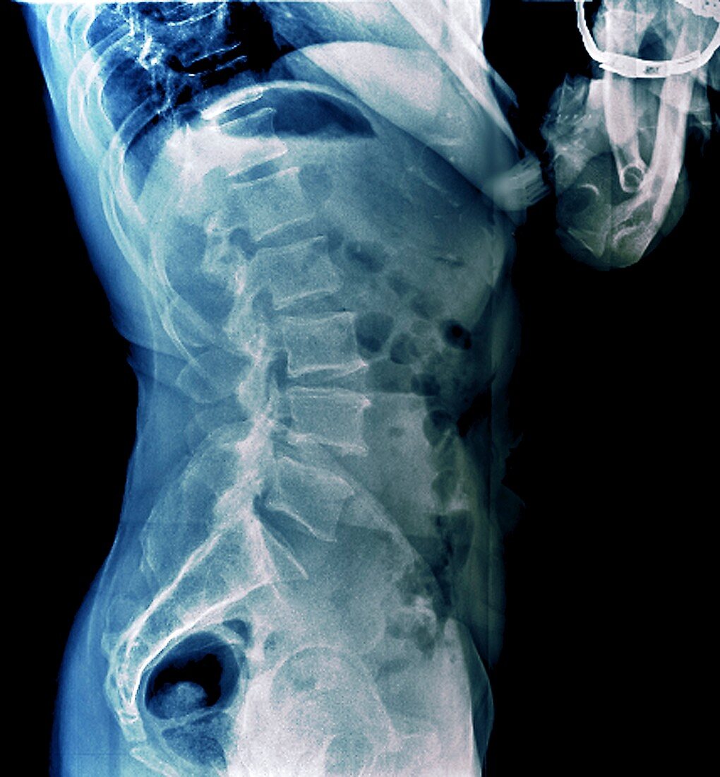 Healthy lower spine, X-ray