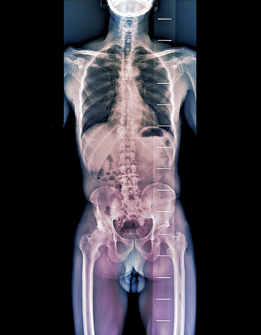 Healthy spine, X-ray