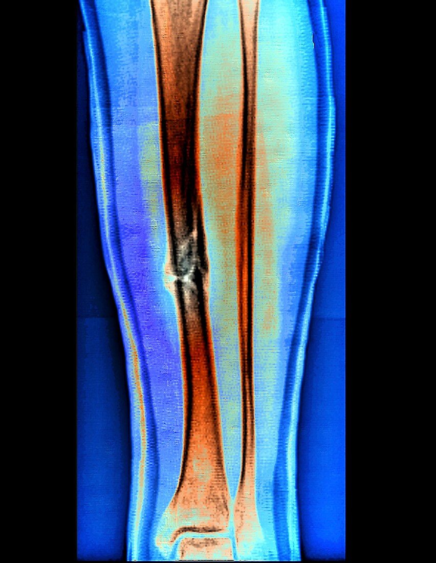 Healing fractured leg, X-ray