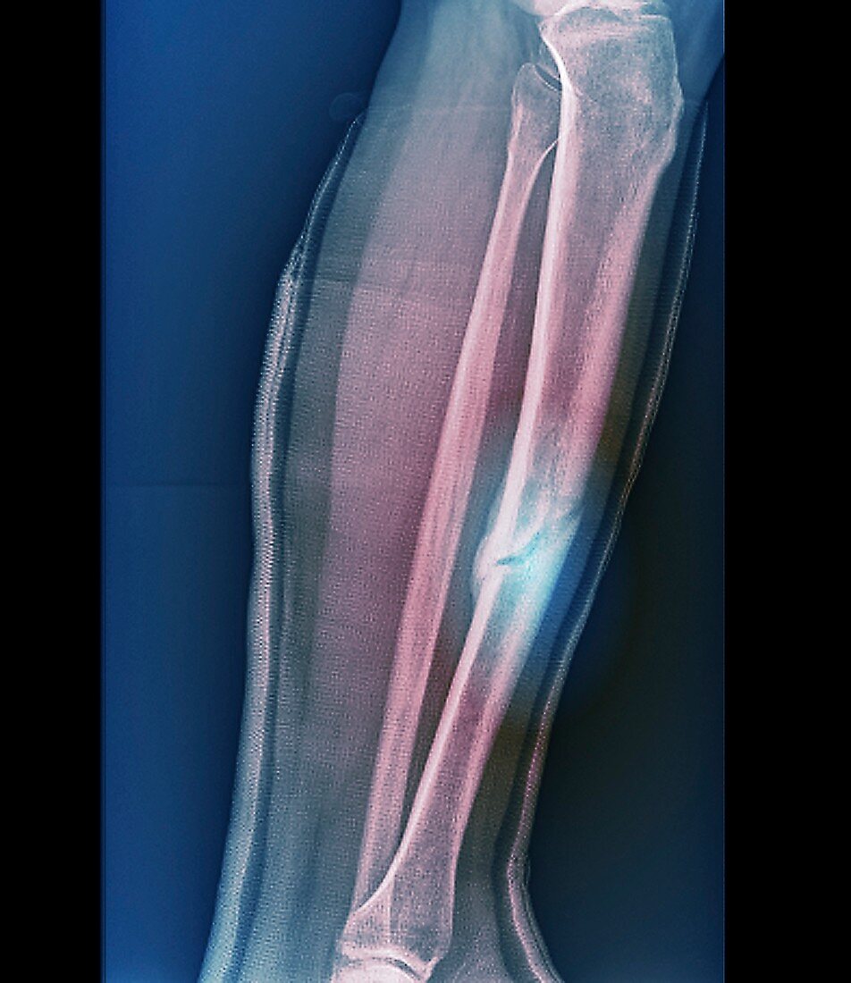 Healing fractured leg, X-ray