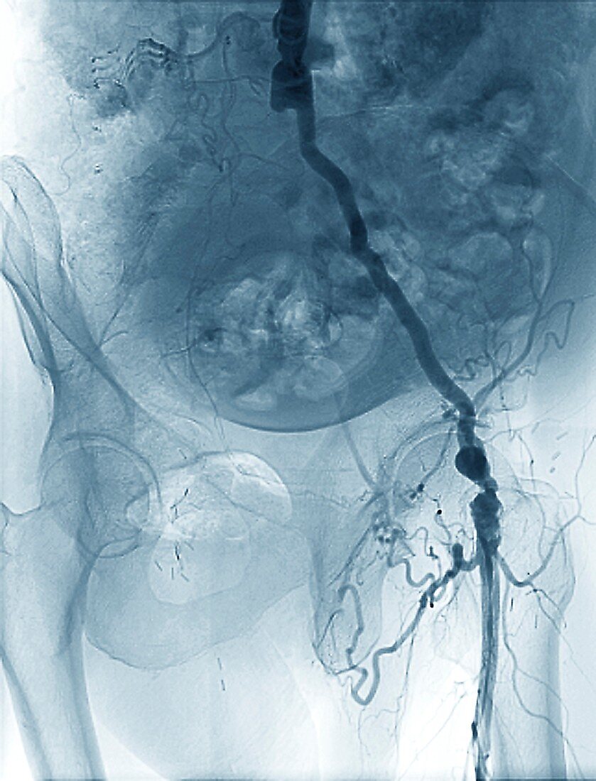 Blocked pelvic artery, X-ray