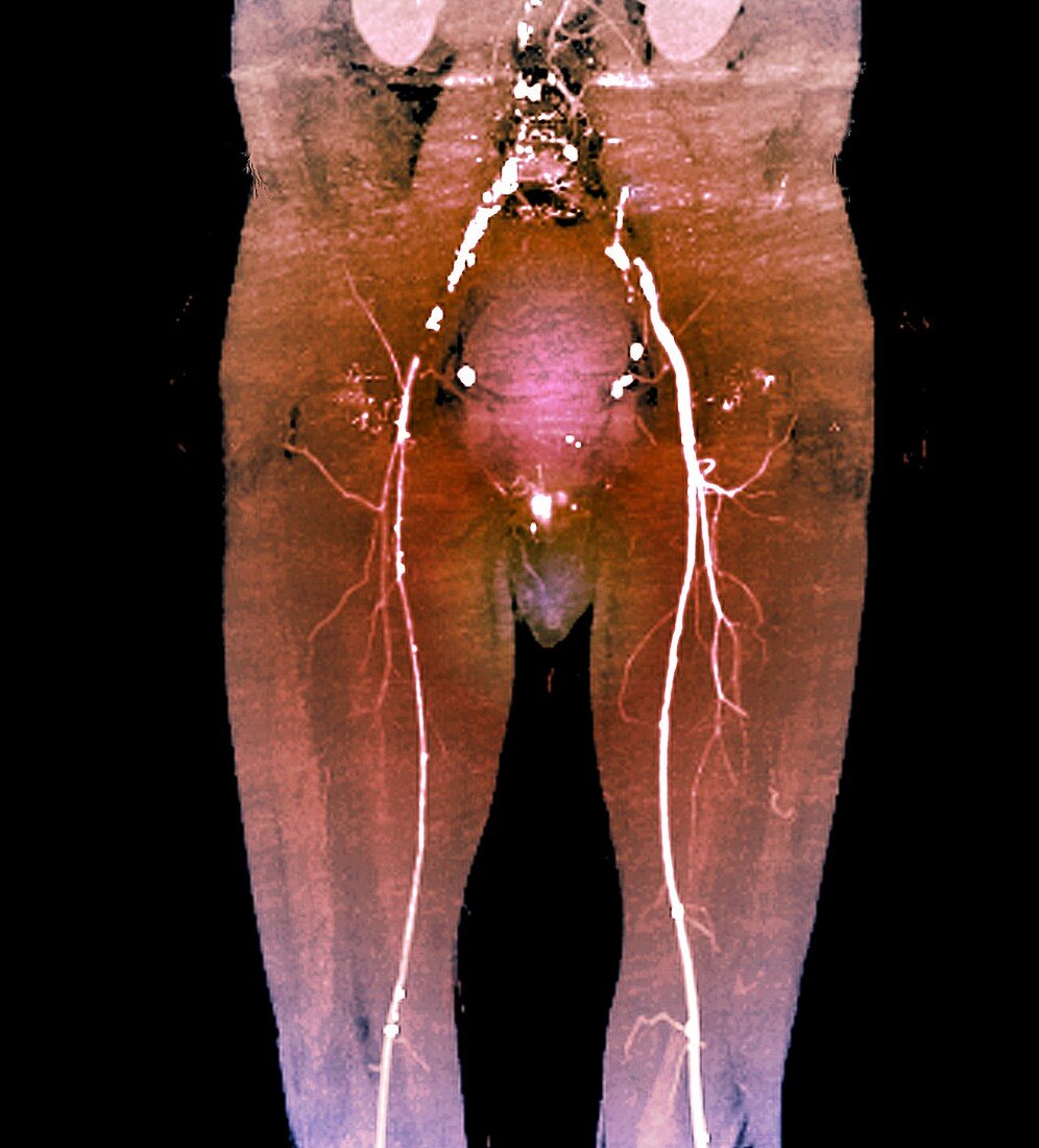 Blocked pelvic artery, CT scan