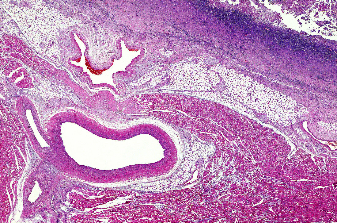 Pleurisy of the lung, light micrograph