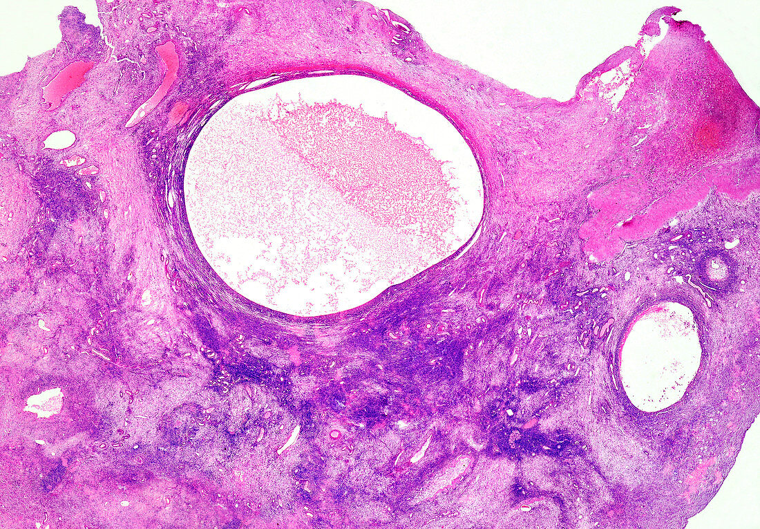 Human ovary cysts, light micrograph