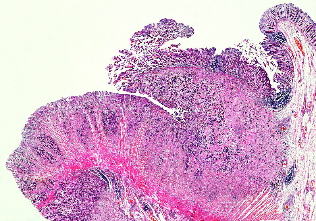 Intestinal adenocarcinoma, light micrograph