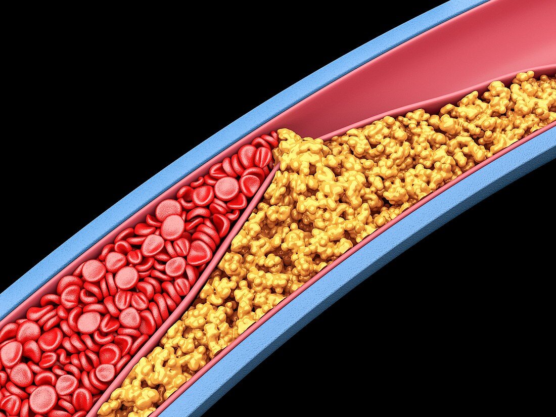 Narrowed artery, illustration