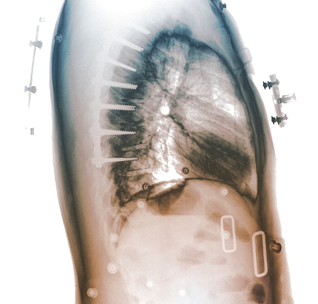 Pinned spinal fracture, X-ray