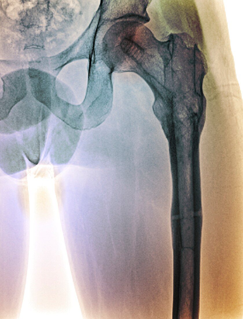 Healing broken hip, X-ray