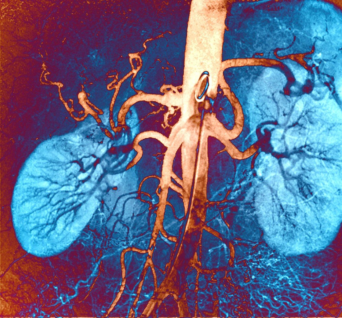 Kidney blood vessels, angiogram