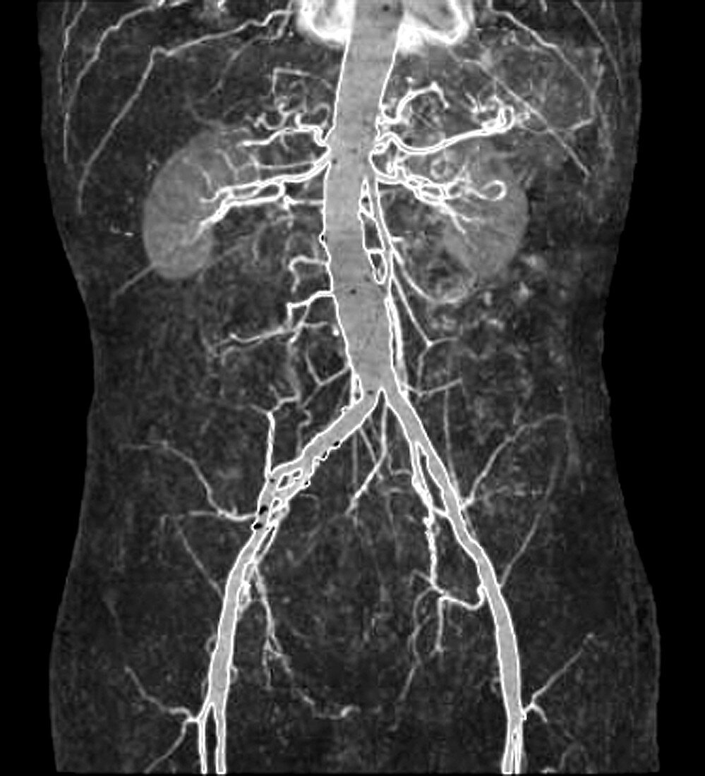 Dilated abdominal aorta, CT scan