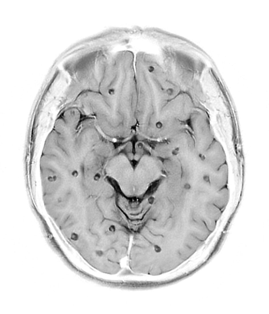 Cysticercosis of the brain, MRI scan