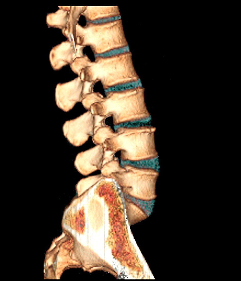 Healthy lower spine, 3D CT scan