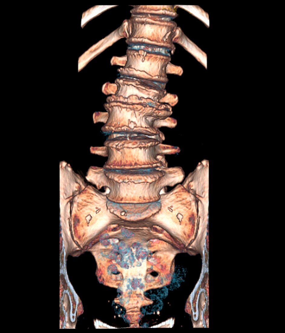 Arthritic spine, 3D CT scan