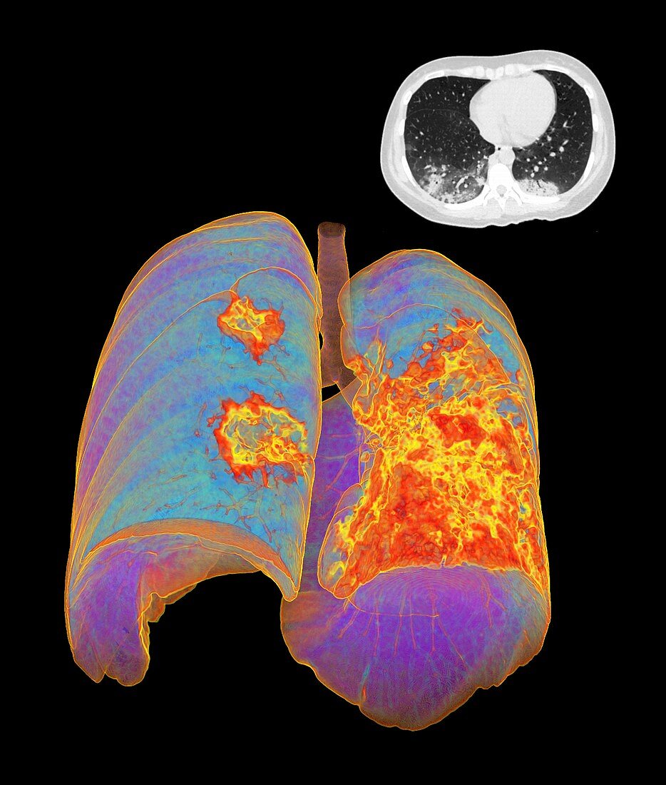 Lungs affected by Covid-19 atypical pneumonia, CT scans