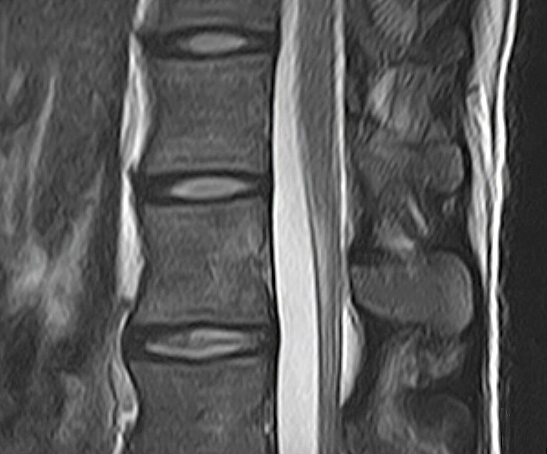 Healthy spine, MRI scan