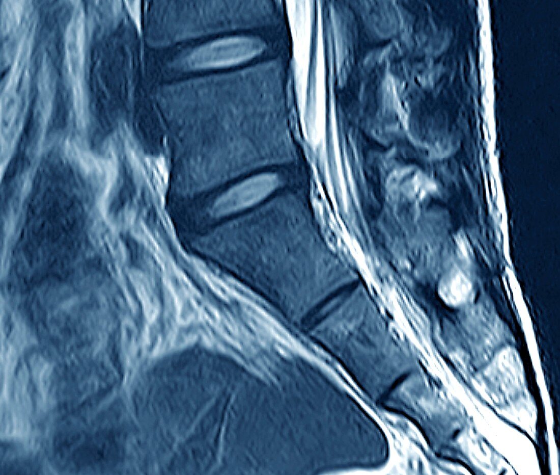 Healthy spine, MRI scan